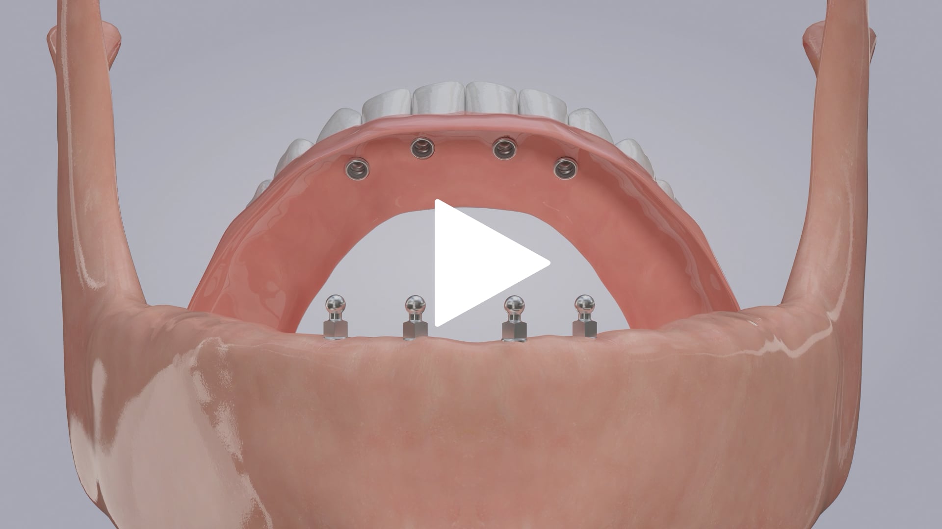 Denture Stabilization with Mini Implants