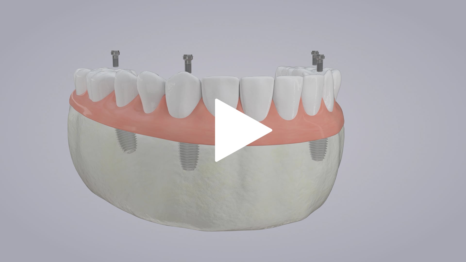 Dental Implants (Full Mouth)